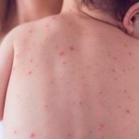 Salud advierte por cuatro casos importados de sarampión