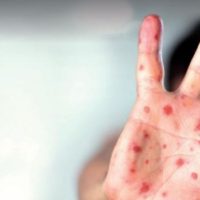 Alerta epidemiológica en Argentina por familia con sarampión que viajó por siete provincias y en micros de larga distancia